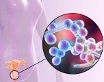 Бактериальный вагиноз у беременных
